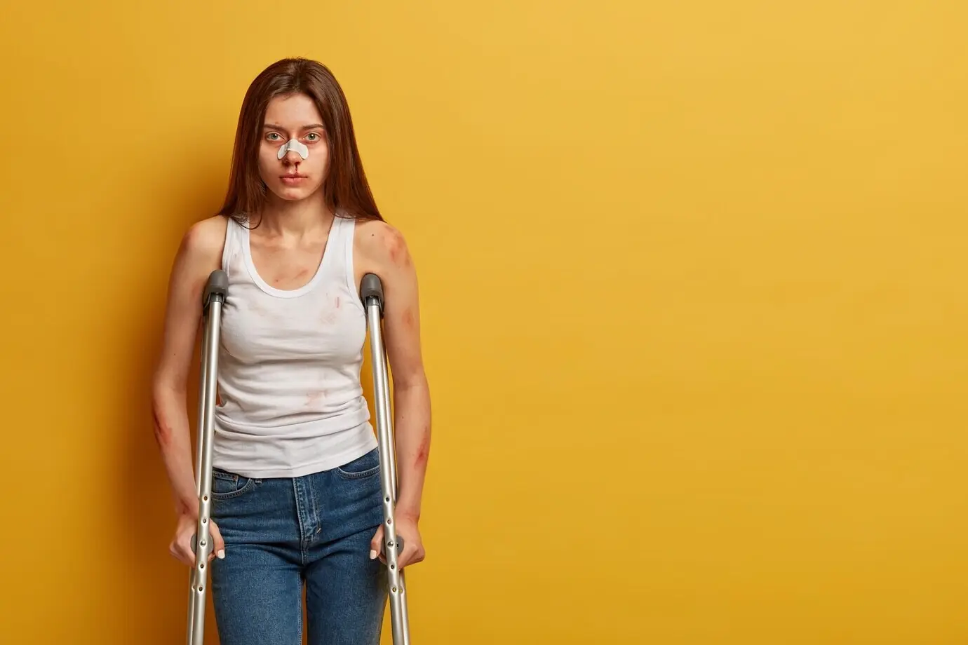 Женщина с синяками и сломанным носом, серьезно пострадавшая.